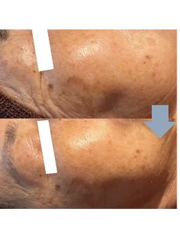 レベンディス(LEVENDIS)/ハーブピーリング×美容液導入