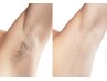 【男女OK/ワキ脱毛/口コミ要】どんな時でも自信を持てる！¥4,000→¥2,000　