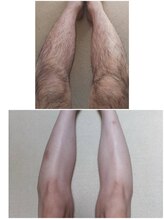 グロー(GLOW)/メンズ足脱毛