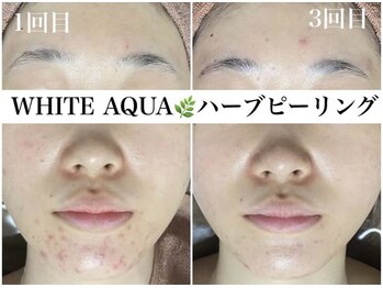 ホワイトアクア 浜松店(WHITE AQUA)/ハーブピーリング/ニキビケア