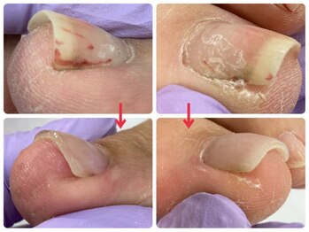 爪処 中野坂上/巻き爪ケア