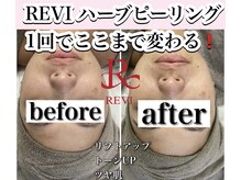 ホリシア 博多(HORISHIA)/ハーブピーリング/ニキビケア