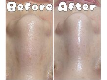 グラシア 倉敷店(Gracia)/ハイドラ毛穴洗浄