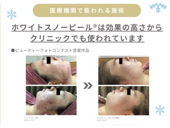 アイル そよら海老江店/ホワイトスノーピール結果