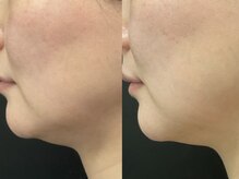 ピュアリー(purly)/【レモンボトル】Before After