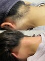 エレナビューティー(Elena Beauty)&nbsp;うなじ脱毛はお任せください！一人一人に合った脱毛を提案します
