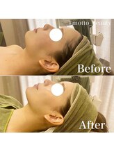 モット 神戸店(Motto)/フェイシャル 小顔矯正