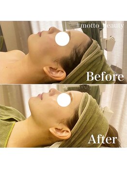 モット 神戸店(Motto)/フェイシャル 小顔矯正