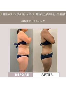 コンバートビューティーオタイ(ConBert Beauty otai)/2週間でこの変化!