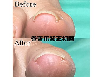巻き爪補正店 八幡店