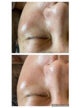 キャピタル(CAPITAL)/ハイドロ毛穴洗浄　フェイシャル