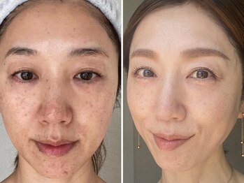トータルエステティック ジョワイユ(JOYEUX)の写真/【お肌が変わると人生が変わる】大人の肌は、ここから変えられる！美肌管理