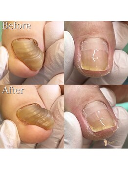 巻き爪補正店 大分店/【巻き爪/魚の目/副爪/タコ】