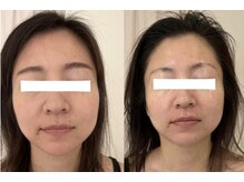 お肌さろん れふぇるんの雰囲気（ヘッド整顔★1回の効果です！効果には個人差がございます）