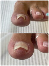 巻き爪じゅん 船橋店/当院の施術で再発予防