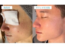 マリーボーテ 名古屋店/【ピーリング８回】毛穴が綺麗に