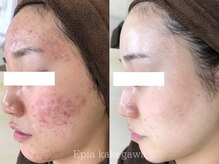 繰り返す頑固なニキビケアはお任せください！