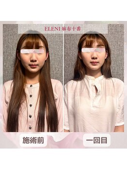 エレーニ 麻布十番(ELENI)/お客様からの感想【小顔矯正】