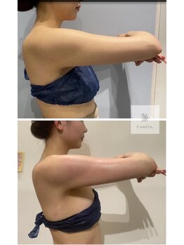 ミセルビューティー 御堂筋本町(micell beauty)/脂肪分解