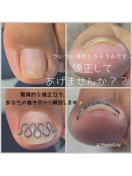 長岡巻き爪矯正センター/巻き爪矯正ビフォーアフター