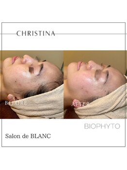 サロン ド ブラン アオヤマ(Salon de BLANC AOYAMA)/CHRISTINAハーブピーリング