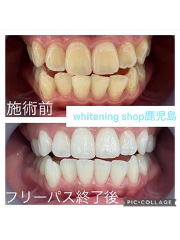 ホワイトニングショップ 鹿児島店/#鹿児島ホワイトニング