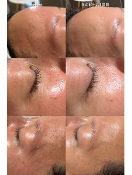 サロンドエピレーション トパーズ(Salon d’ epilation TOPARDS)/ラミピールの効果！