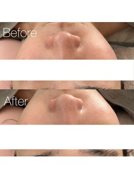 プララン 京都桂店(Plaran)/【毛穴洗浄】