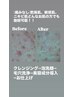 《大人の毛穴》お肌に優しい！ダメージレス毛穴洗浄！50分