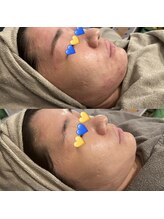 ブルー(blue.)/剥離ありハードハーブピーリング