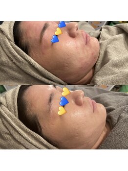 ブルー(blue.)/剥離ありハードハーブピーリング