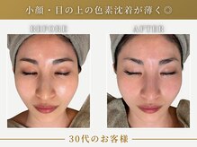 リムーン(REMOON.)/施術後の効果★30代のお客様