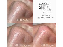 ジプソフィラフィフティドット(gypsophira15.)の雰囲気（毛穴が変われば肌が変わる。肌質・ニキビ肌質改善に！）