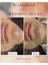 オフ(off)/顎ヒゲ脱毛