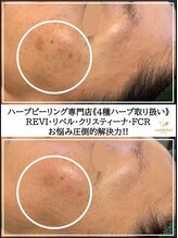 キャンディ 岐阜(CANDi)&nbsp;毛穴開き 徹底改善