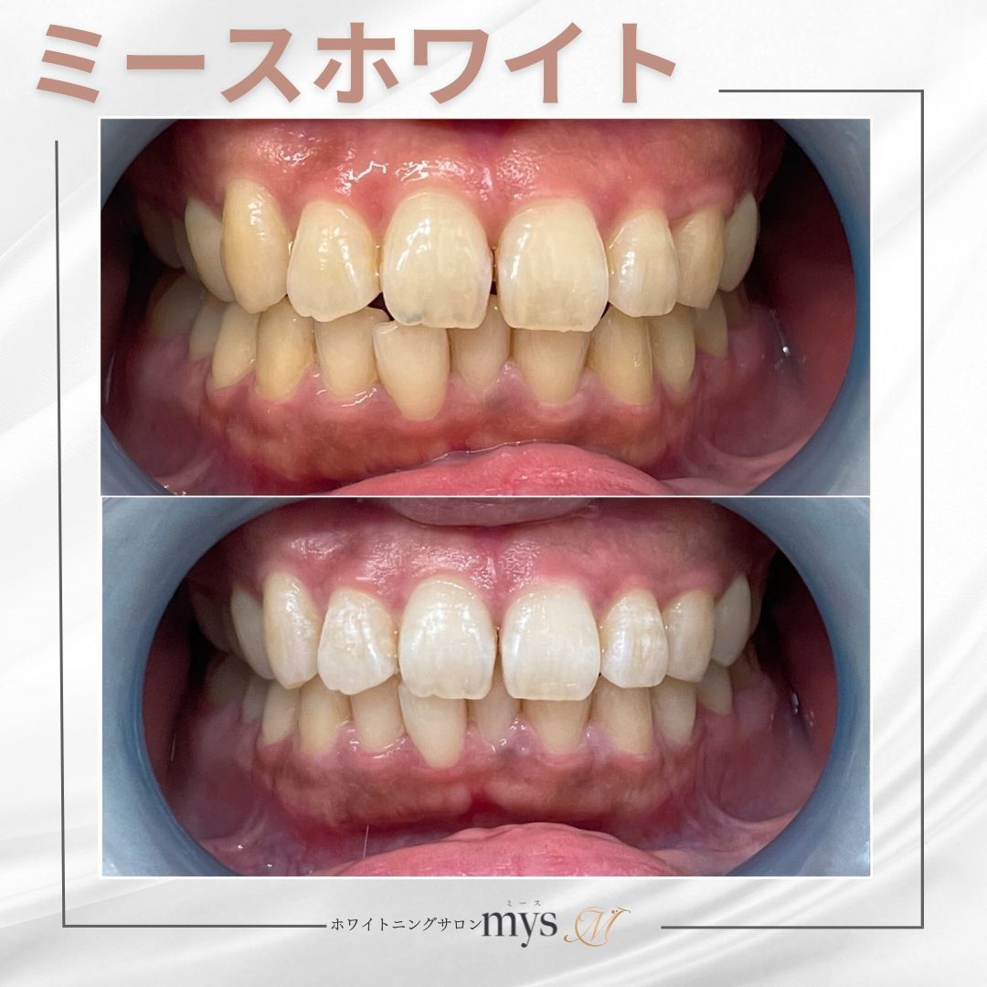 ★初回限定★美白セルフホワイトニング9分照射\5,500→\3,000