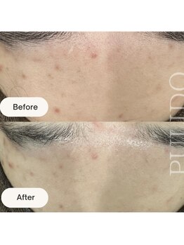 プリドー(PULIDO)/PULIDO式肌育メソッド