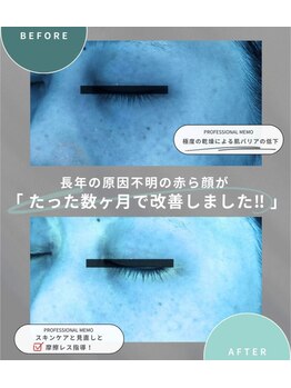 エーティーセンターラボ(At.center labo)/結果の出る赤ら顔プログラム