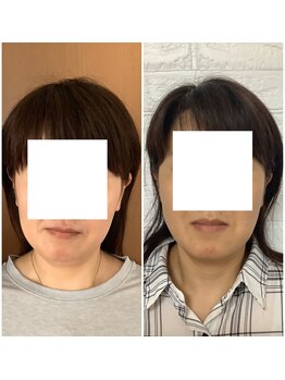 ビューティフルムーン(Beautiful Moon)/顎の歪みの改善