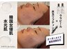 【内側から輝く水光肌に】ダウンタイムなしで韓国女優肌へ◎¥20500→¥18000