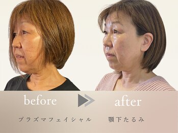 グロッシー(glossy)/【症例】プラズマ顎たるみ50代