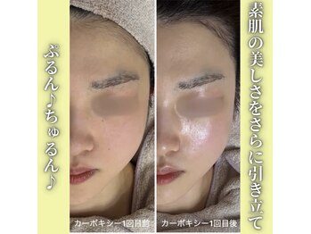 ハニエル(Haniel)/カーボキシー症例