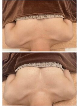 美人バスト 豊橋店/バストアップ症例【バストケア】