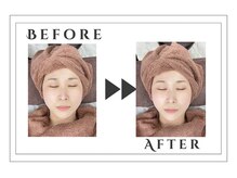 アルゴ 志免店(ALGO)/劇的変化！光フェイシャル