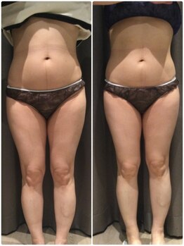 アイスタイル(i-style)/脂肪冷却/痩身ダイエット/泉大津