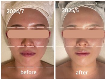 ルナビューティー 赤坂(LUNA beauty)/輪郭矯正フェイシャルエステ