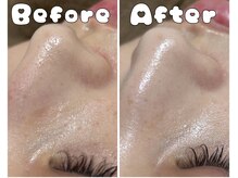 グラシア 倉敷店(Gracia)/ハイドラ毛穴洗浄