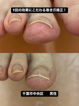 巻き爪じゅん 船橋店/1回で改善千葉市中央区の巻き爪
