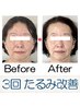 【 頬のたるみ・ほうれい線に】効果に感動☆ たるみ改善コース 3回プラン