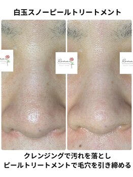 ローマサロン/白玉スノーピールトリートメント